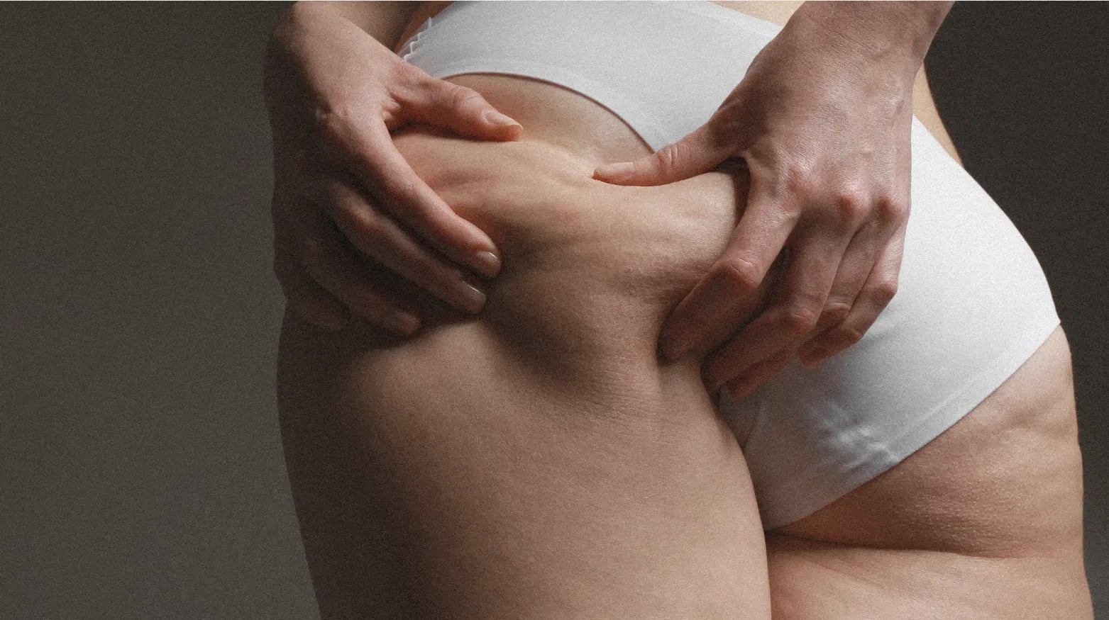 Lipödem: Symptome, Ursachen und was wirklich hilft - Hormonic